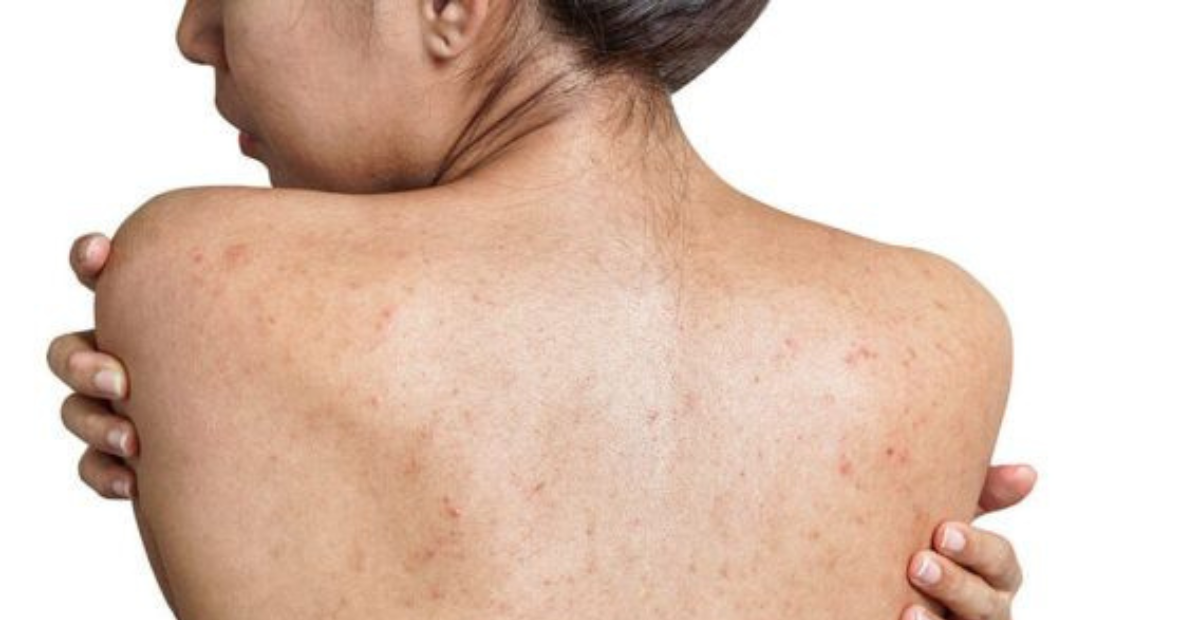 Punggung Sering Berjerawat